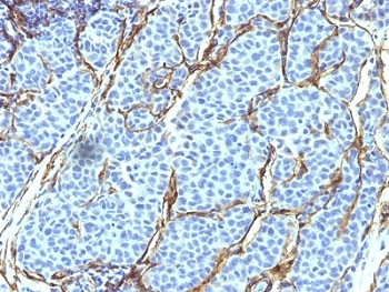 NGFR / CD271 / TNR16 Antibody - Formalin-fixed, paraffin-embedded human melanoma stained with NGF Receptor antibody (SPM299).  This image was taken for the unmodified form of this product. Other forms have not been tested.