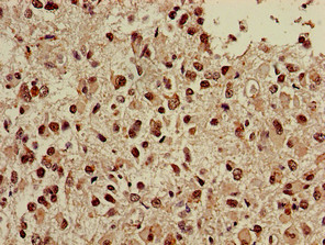 NGFR / CD271 / TNR16 Antibody - Immunohistochemistry of paraffin-embedded human glioma cancer using NGFR Antibody at dilution of 1:100