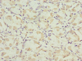 NGFRAP1 / NADE / Bex Antibody - Immunohistochemistry of paraffin-embedded human gastric cancer at dilution 1:100