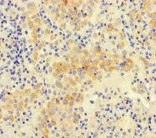 NGN / Neogenin Antibody - Immunohistochemistry of paraffin-embedded human lung cancer at dilution of 1:100