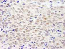 NHEJ1 / XLF Antibody - Detection of Human XLF by Immunohistochemistry. Sample: FFPE section of human breast carcinoma. Antibody: Affinity purified rabbit anti-XLF used at a dilution of 1:1000 (1 ug/ml). Detection: DAB.