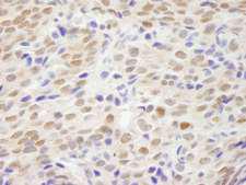 NHEJ1 / XLF Antibody - Detection of Human XLF by Immunohistochemistry. Sample: FFPE section of human breast carcinoma. Antibody: Affinity purified rabbit anti-XLF used at a dilution of 1:200 (1 ug/ml). Detection: DAB.