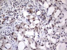 NHEJ1 / XLF Antibody - Immunohistochemical staining of paraffin-embedded Carcinoma of Human lung tissue using anti-NHEJ1 Mouse monoclonal antibody.  heat-induced epitope retrieval by 1 mM EDTA in 10mM Tris, pH8.5, 120C for 3min)