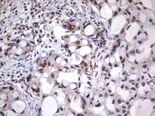 NHEJ1 / XLF Antibody - IHC of paraffin-embedded Carcinoma of Human lung tissue using anti-NHEJ1 Mouse monoclonal antibody. (heat-induced epitope retrieval by 1 mM EDTA in 10mM Tris, pH8.5, 120°C for 3min).