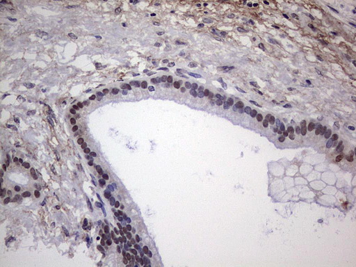NHEJ1 / XLF Antibody - IHC of paraffin-embedded Carcinoma of Human pancreas tissue using anti-NHEJ1 Mouse monoclonal antibody. (heat-induced epitope retrieval by 1 mM EDTA in 10mM Tris, pH8.5, 120°C for 3min).