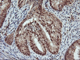 NHEJ1 / XLF Antibody - IHC of paraffin-embedded Adenocarcinoma of Human endometrium tissue using anti-NHEJ1 mouse monoclonal antibody.