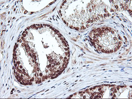 NHEJ1 / XLF Antibody - IHC of paraffin-embedded Carcinoma of Human prostate tissue using anti-NHEJ1 mouse monoclonal antibody.