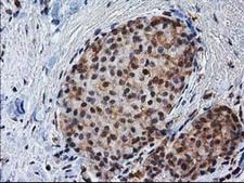 NHEJ1 / XLF Antibody - IHC of paraffin-embedded Adenocarcinoma of Human breast tissue using anti-NHEJ1 mouse monoclonal antibody.