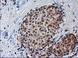 NHEJ1 / XLF Antibody - IHC of paraffin-embedded Adenocarcinoma of Human breast tissue using anti-NHEJ1 mouse monoclonal antibody.