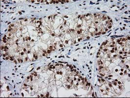 NHEJ1 / XLF Antibody - IHC of paraffin-embedded Adenocarcinoma of Human ovary tissue using anti-NHEJ1 mouse monoclonal antibody.