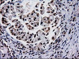 NHEJ1 / XLF Antibody - IHC of paraffin-embedded Adenocarcinoma of Human colon tissue using anti-NHEJ1 mouse monoclonal antibody.