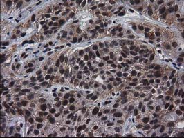 NHEJ1 / XLF Antibody - IHC of paraffin-embedded Carcinoma of Human bladder tissue using anti-NHEJ1 mouse monoclonal antibody.