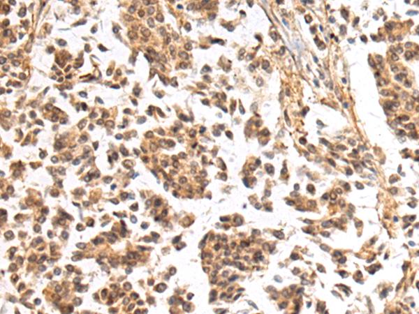 NHLRC2 Antibody - Immunohistochemistry of paraffin-embedded Human breast cancer tissue  using NHLRC2 Polyclonal Antibody at dilution of 1:40(×200)