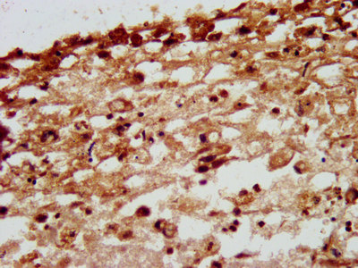 NID1 / Entactin / Nidogen-1 Antibody - Immunohistochemistry image at a dilution of 1:200 and staining in paraffin-embedded human melanoma cancer performed on a Leica BondTM system.