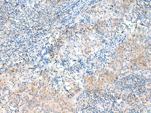NID2 / Nidogen-2 Antibody - Immunohistochemistry of paraffin-embedded Human cervical cancer tissue  using NID2 Polyclonal Antibody at dilution of 1:50(×200)