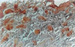 NIFK / MKI67IP Antibody - NIFK KI67ip -immunostaining in adipocytes of human Carcinomatous Breast tissue using antibody at 1:500 dilution.