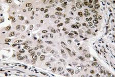 NIFK / MKI67IP Antibody - IHC of NIFK (D229) pAb in paraffin-embedded human lung carcinoma tissue.