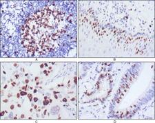 NIFK / MKI67IP Antibody - IHC of paraffin-embedded human lymph node (A), esophagus (B), lung cancer (C), rectum cancer (D), showing nuclear localization using KI67 mouse monoclonal antibody with DAB staining.