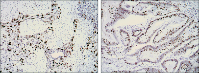 NIFK / MKI67IP Antibody - IHC of paraffin-embedded lung cancer (left) and rectal cancer (right) using KI67 mouse monoclonal antibody with DAB staining.