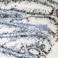 NIFK / MKI67IP Antibody - Immunohistochemical analysis of MKI67IP staining in human colon cancer formalin fixed paraffin embedded tissue section. The section was pre-treated using heat mediated antigen retrieval with sodium citrate buffer (pH 6.0). The section was then incubated with the antibody at room temperature and detected using an HRP conjugated compact polymer system. DAB was used as the chromogen. The section was then counterstained with hematoxylin and mounted with DPX.