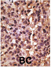 NIP3 / BNIP3 Antibody - Formalin-fixed and paraffin-embedded human cancer tissue reacted with the primary antibody, which was peroxidase-conjugated to the secondary antibody, followed by DAB staining. This data demonstrates the use of this antibody for immunohistochemistry; clinical relevance has not been evaluated. BC = breast carcinoma; HC = hepatocarcinoma.