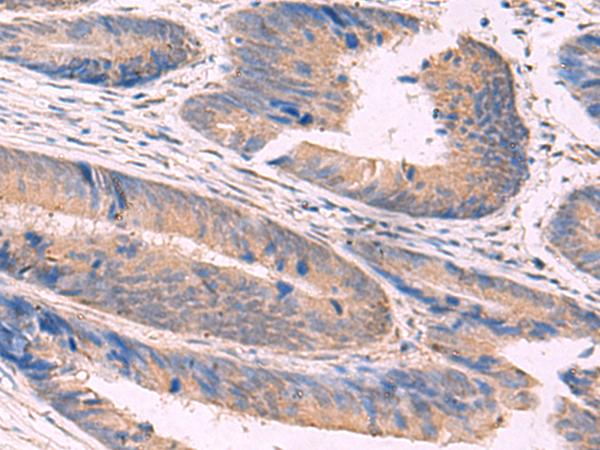 NIPSNAP1 Antibody - Immunohistochemistry of paraffin-embedded Human colorectal cancer tissue  using NIPSNAP1 Polyclonal Antibody at dilution of 1:50(×200)