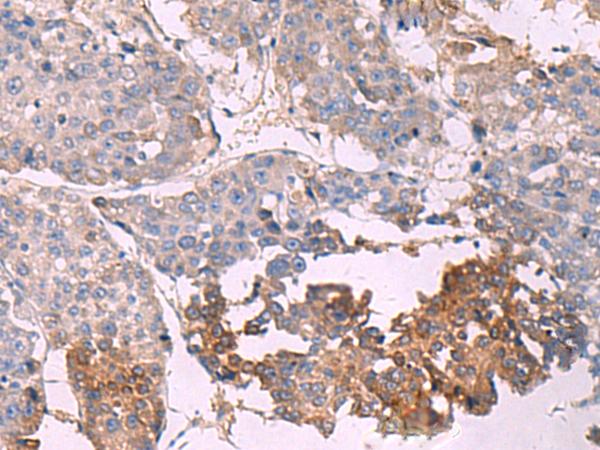 NIPSNAP1 Antibody - Immunohistochemistry of paraffin-embedded Human liver cancer tissue  using NIPSNAP1 Polyclonal Antibody at dilution of 1:35(×200)