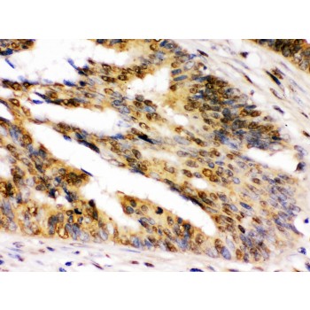 NIRF / UHRF2 Antibody - NIRF was detected in paraffin-embedded sections of human intestinal cancer tissues using rabbit anti- NIRF Antigen Affinity purified polyclonal antibody at 1 ug/mL. The immunohistochemical section was developed using SABC method.