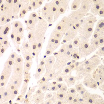NIRF / UHRF2 Antibody - Immunohistochemistry of paraffin-embedded human liver cancer using UHRF2 antibody at dilution of 1:200 (40x lens).
