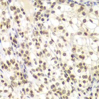 NIRF / UHRF2 Antibody - Immunohistochemistry of paraffin-embedded human kidney cancer using UHRF2 antibody at dilution of 1:200 (40x lens).