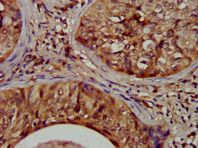 NIT1 Antibody - IHC image of NIT1 Antibody diluted at 1:1200 and staining in paraffin-embedded human cervical cancer performed on a Leica BondTM system. After dewaxing and hydration, antigen retrieval was mediated by high pressure in a citrate buffer (pH 6.0). Section was blocked with 10% normal goat serum 30min at RT. Then primary antibody (1% BSA) was incubated at 4°C overnight. The primary is detected by a biotinylated secondary antibody and visualized using an HRP conjugated SP system.