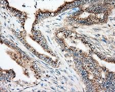 NIT2 Antibody - Immunohistochemical staining of paraffin-embedded Adenocarcinoma of colon tissue using anti-NIT2 mouse monoclonal antibody. (Dilution 1:50).