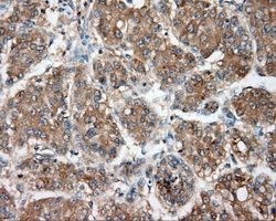 NIT2 Antibody - Immunohistochemical staining of paraffin-embedded Carcinoma of liver tissue using anti-NIT2 mouse monoclonal antibody. (Dilution 1:50).