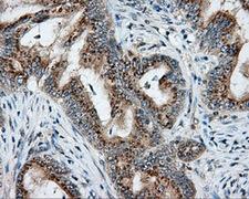 NIT2 Antibody - Immunohistochemical staining of paraffin-embedded Adenocarcinoma of colon tissue using anti-NIT2 mouse monoclonal antibody. (Dilution 1:50).