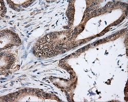 NIT2 Antibody - IHC of paraffin-embedded Adenocarcinoma of colon tissue using anti-NIT2 mouse monoclonal antibody. (Dilution 1:50).