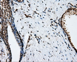 NIT2 Antibody - IHC of paraffin-embedded Carcinoma of prostate tissue using anti-NIT2 mouse monoclonal antibody. (Dilution 1:50).