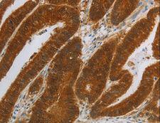 NIT2 Antibody - Immunohistochemistry of paraffin-embedded Human colon cancer using NIT2 Polyclonal Antibody at dilution of 1:40.