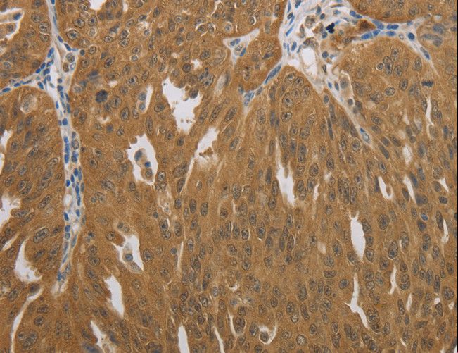 NIT2 Antibody - Immunohistochemistry of paraffin-embedded Human ovarian cancer using NIT2 Polyclonal Antibody at dilution of 1:40.