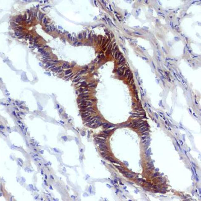 Nitrotyrosine Antibody - Immunohistochemistry staining (frozen sections) of human tumoral colon epithelium with anti-nitrotyrosine antibody (EM-30).