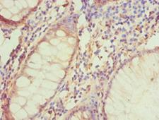 NIX / BNIP3L Antibody - Immunohistochemistry of paraffin-embedded human colon cancer using antibody at 1:100 dilution.