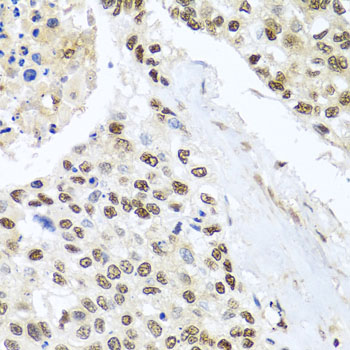 NIX / BNIP3L Antibody - Immunohistochemistry of paraffin-embedded human lung cancer tissue.