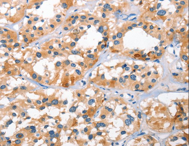 NIX / BNIP3L Antibody - Immunohistochemistry of paraffin-embedded Human gastric cancer using BNIP3L Polyclonal Antibody at dilution of 1:40.