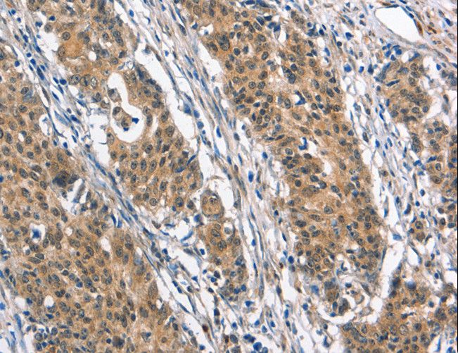 NIX / BNIP3L Antibody - Immunohistochemistry of paraffin-embedded Human gastric cancer using BNIP3L Polyclonal Antibody at dilution of 1:40.