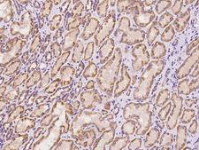 NIX / BNIP3L Antibody - Immunochemical staining of human BNIP3L in human breast carcinoma with rabbit polyclonal antibody at 1:1000 dilution, formalin-fixed paraffin embedded sections.
