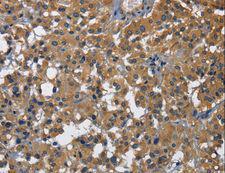 NK1 / CD160 Antibody - Immunohistochemistry of paraffin-embedded Human thyroid cancer using CD160 Polyclonal Antibody at dilution of 1:30.