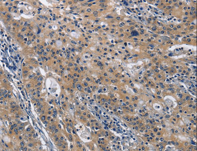NK1 / CD160 Antibody - Immunohistochemistry of paraffin-embedded Human gastric cancer using CD160 Polyclonal Antibody at dilution of 1:30.