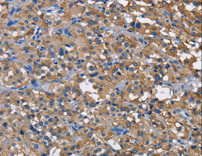 NK1 / CD160 Antibody - Immunohistochemistry of paraffin-embedded Human thyroid cancer using CD160 Polyclonal Antibody at dilution of 1:60.