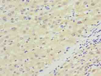 NKAIN4 / C20orf58 Antibody - Immunohistochemistry of paraffin-embedded human liver cancer using antibody at dilution of 1:100.