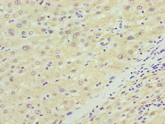 NKAIN4 / C20orf58 Antibody - Immunohistochemistry of paraffin-embedded human liver cancer using NKAIN4 Antibody at dilution of 1:100