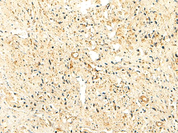 NKD2 Antibody - Immunohistochemistry of paraffin-embedded Human prost ate cancer tissue  using NKD2 Polyclonal Antibody at dilution of 1:50(×200)